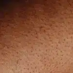 Keratosis Pilaris Treatment in KL