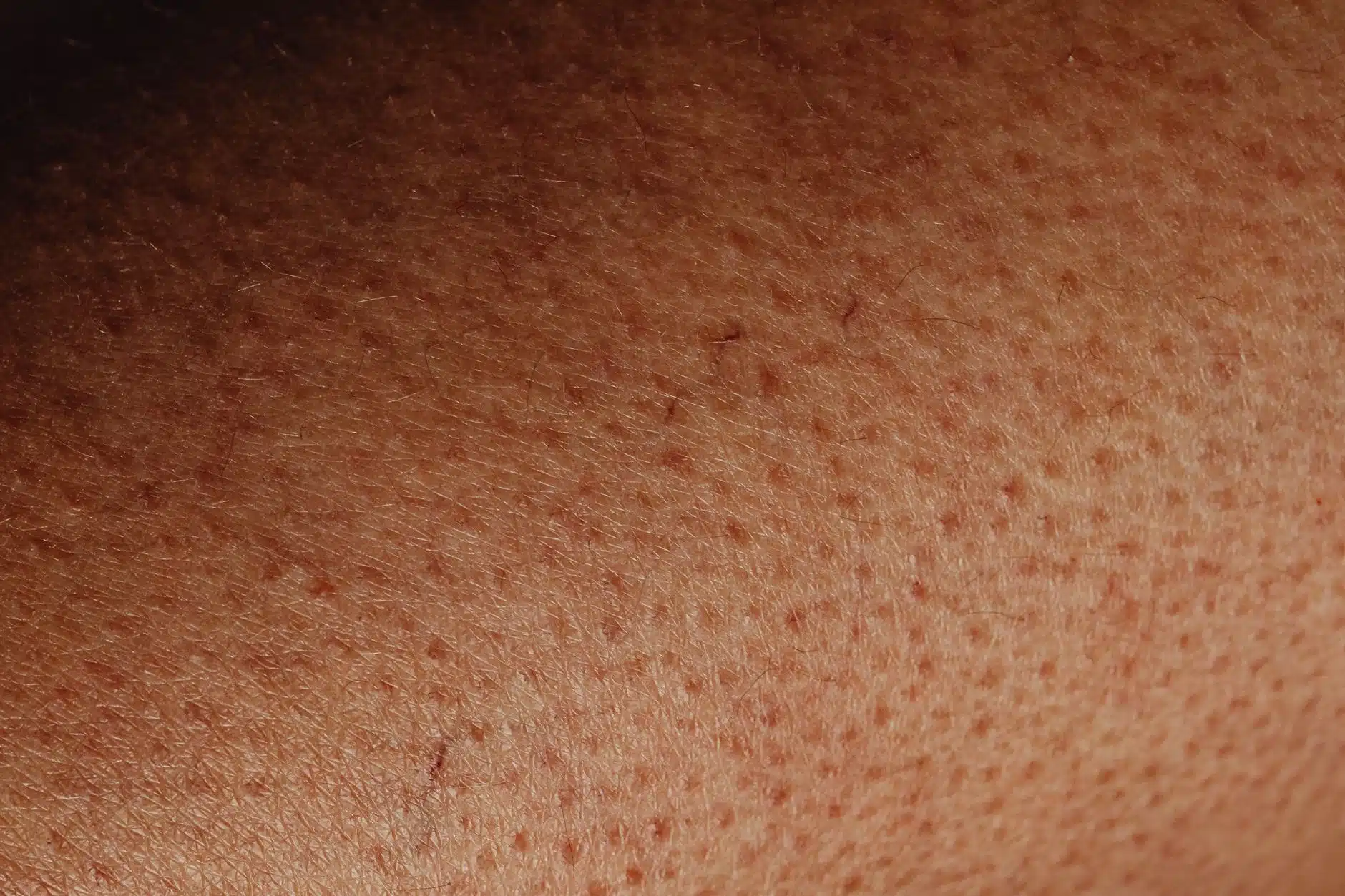 Keratosis Pilaris Treatment in KL