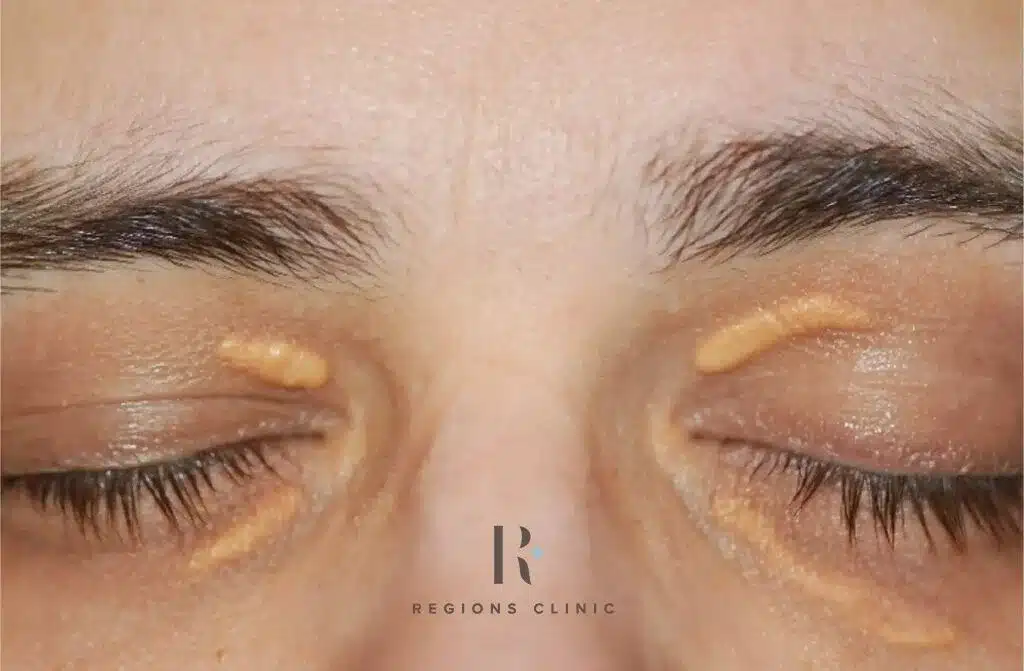 Xanthelasma Eyelids Treatment KL