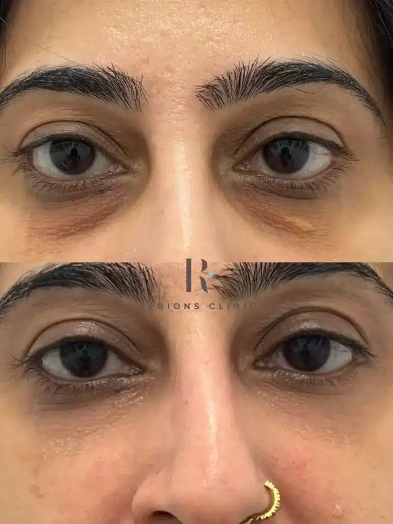 Xanthelasma Removal Before and After Malaysia