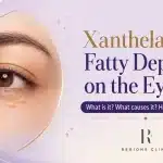 Xanthelasma Removal Malaysia