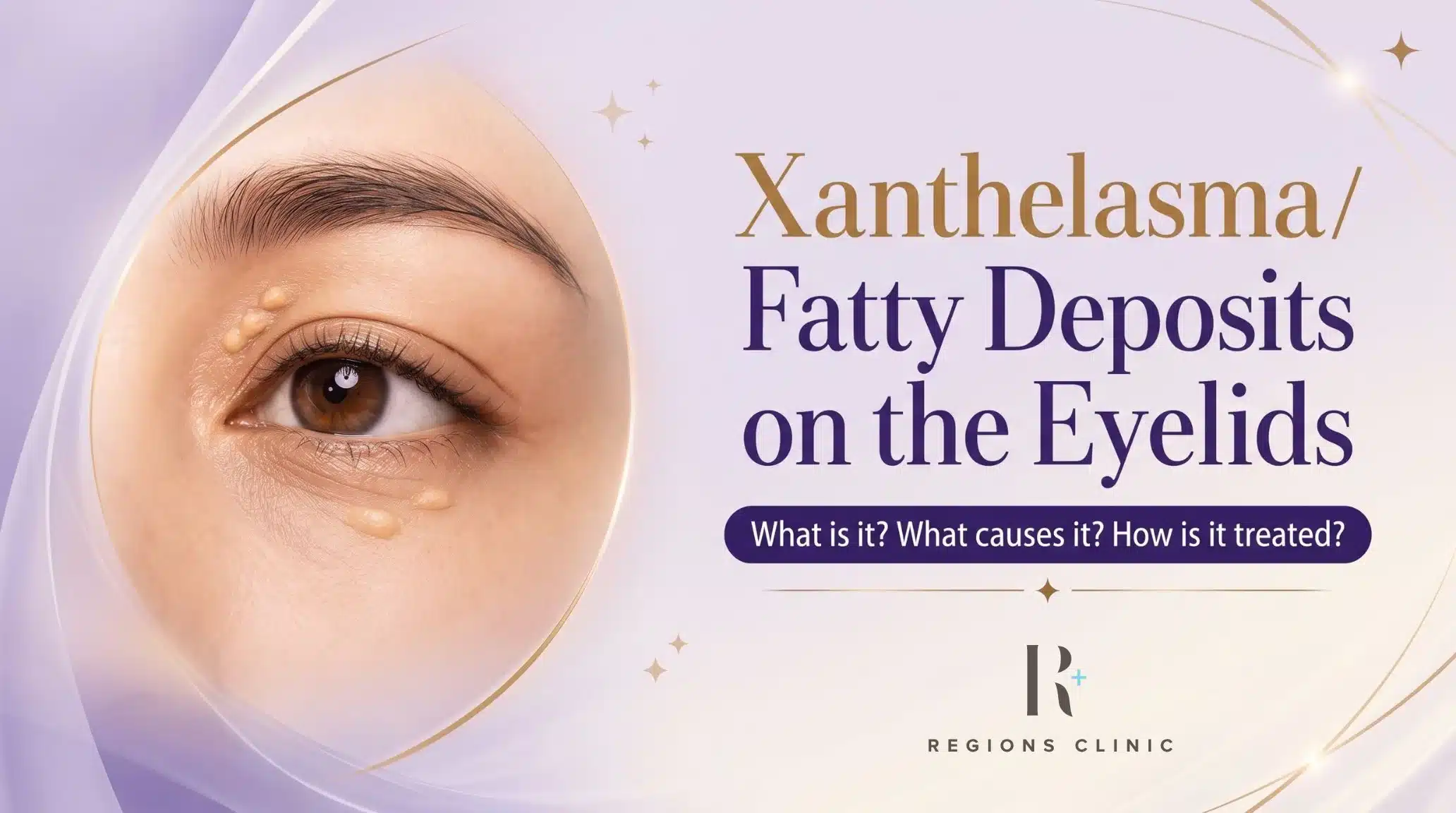 Xanthelasma Removal Malaysia