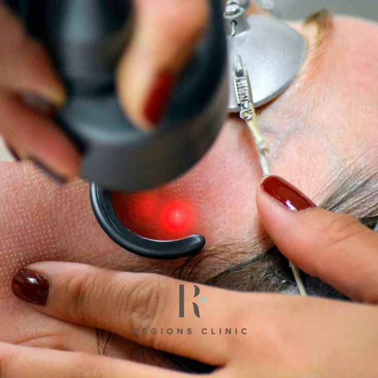 Laser treatment procedure targeting acne scars on the skin.