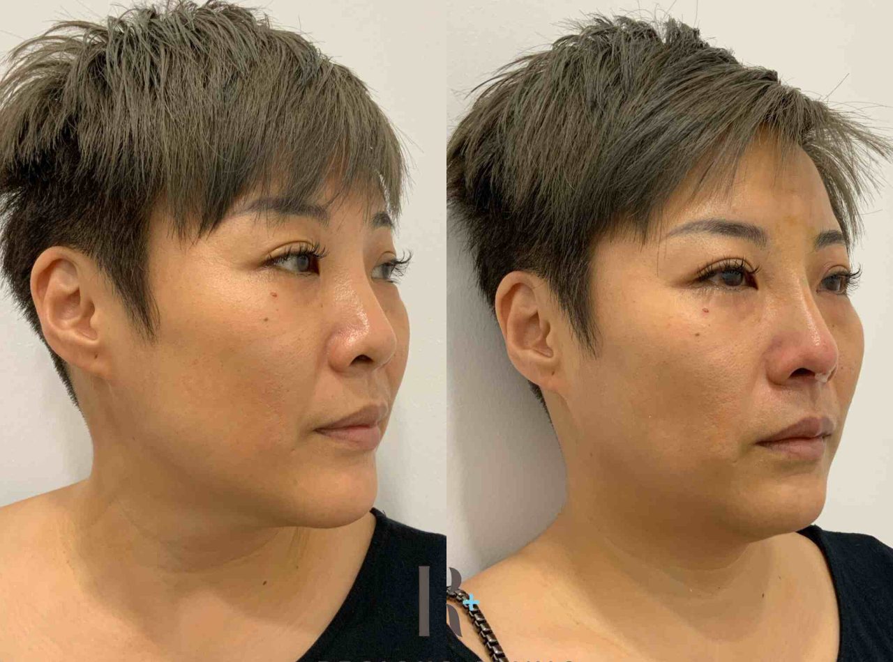 best nost thread lift malaysia